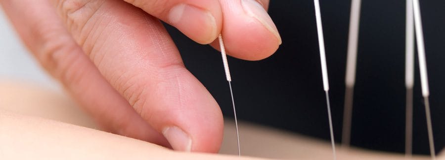 acupuncture