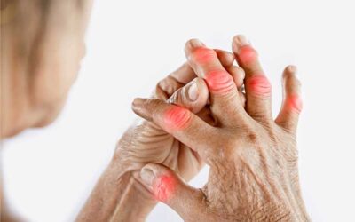 Arthritis: A Comprehensive Guide to Understanding, Managing, and Living Well