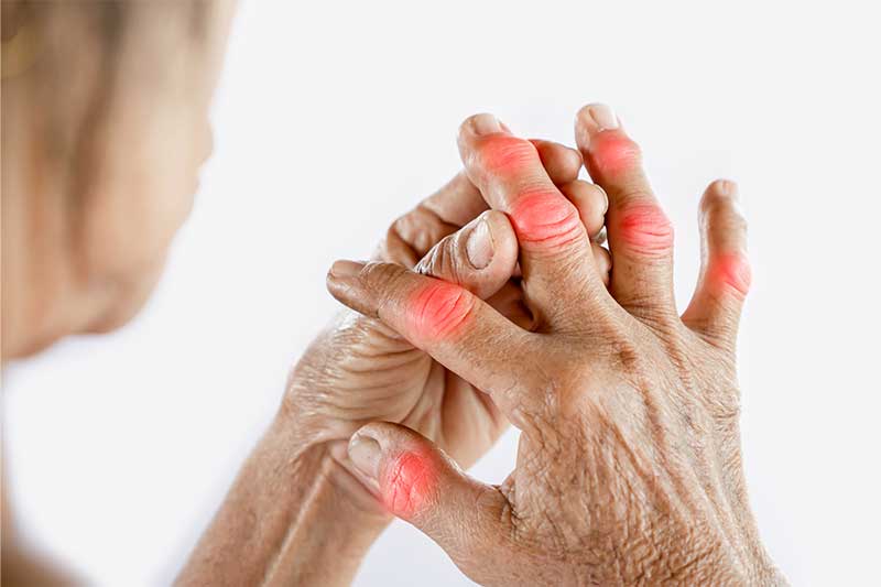 Arthritis: A Comprehensive Guide to Understanding, Managing, and Living Well