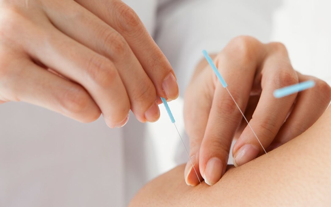 Acupuncture and Its Benefits for Anxiety Disorders