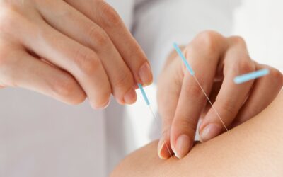 Acupuncture and Its Benefits for Anxiety Disorders